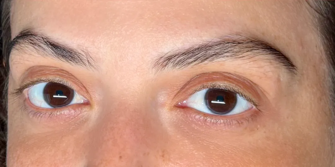 Nanoblading result: soft, natural hair strokes on both brows
